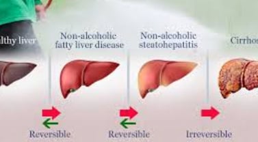 Fatty Liver Disease irreversable cirrosis