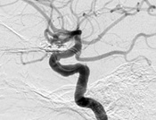 Angiografia digital após a cirurgia no cérebro e clipagem do aneurisma cerebral.