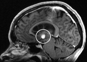 Ressonância cote sagital da mesma mulher, com cisto coóide e hidrecefalia obstrutiva.