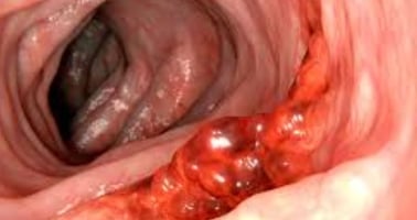 _bleeding from anus with pain