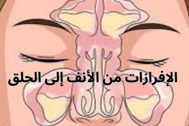 علاج إفرازات الأنف الخلفية الناجمة عن التهابات الجيوب