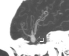 Angiotomografia projeção perfil. A seta indica o aneurisma cerebral.