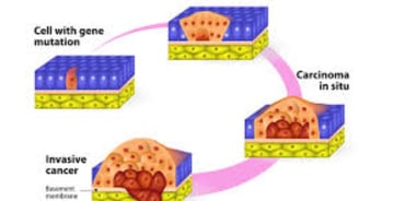 ca bladder