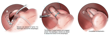 nissen fundoplication