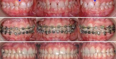 agenesie alfortville docteur der Invisalign orthodontie