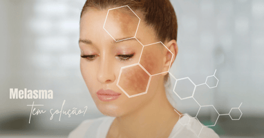 melasma no rosto