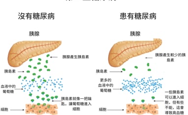第二型糖尿病