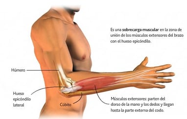 Epicondilitis o codo de tenista