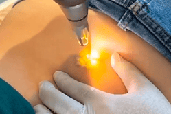 tatoeage verwijderen met picolaser amersfoort