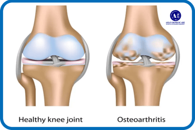 OA Knee