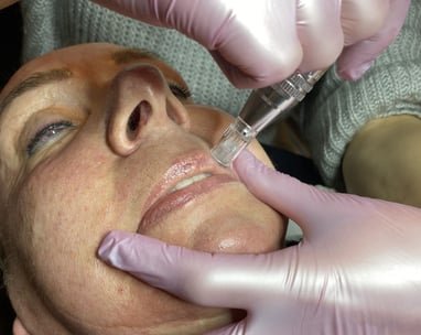 microneedling is de beste anti-age gezichtsbehandeling