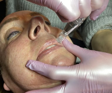 microneedling is de beste anti-age gezichtsbehandeling