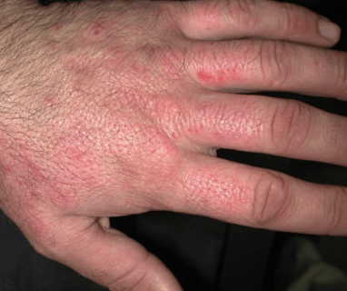 Irritant Contact Dermatitis