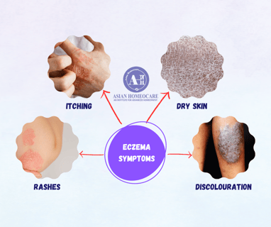 Eczema Symptoms