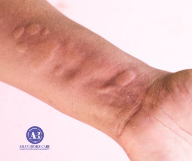 Urticaria Homeopathic treatment