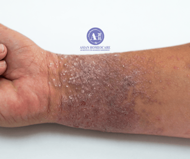 Atopic dermatitis (Eczema) Homeopathic treatment