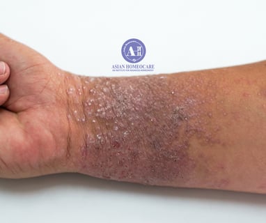 Eczema, Atopic Dermatitis