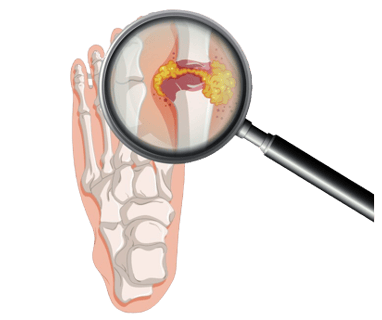 Gout