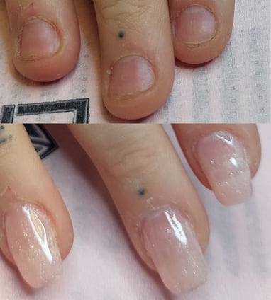 Behandling för nagelbitare