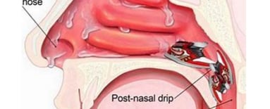   drop in the nose and throat