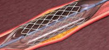 stent placement