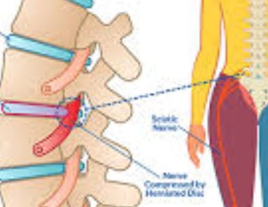 a diagram of a spinal disc  