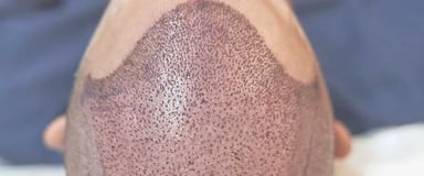 Hair Transplant ray and rio's speciality clinic
