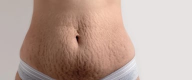 Stretch Marks ray and rio's speciality clinic