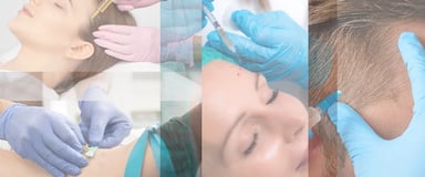 PRP for Hair ray and rio's speciality clinic