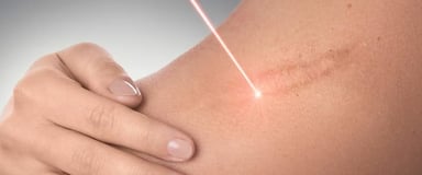Laser Scar Revision ray and rio's speciality clinic