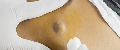​Sebaceous Cyst Removal ray and rio's speciality clinic
