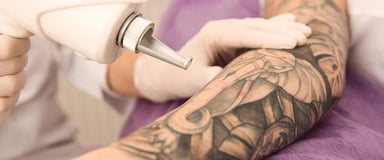 Laser Tattoo Removal ray and rio's speciality clinic