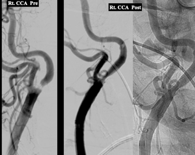 Done by Dr Nishant Aditya, an interventional neuroradiologist.