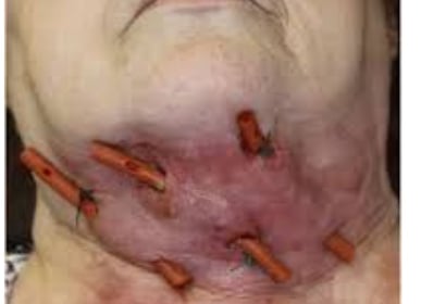 necrotizing-fasciitis