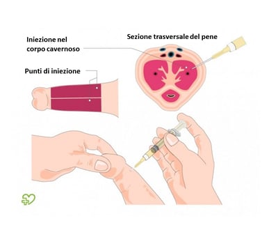 iniezione intracavernosa del pene di prostaglandine