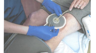 a nurse applying wound vac on patient wound.