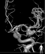 Angiografia digital projeção frontal. A seta indica aneurisma cerebral.
