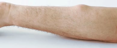 Lipoma Removal ray and rio's speciality clinic