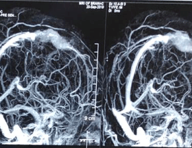 Residual tumour after surgery, treated with Radiosurgery