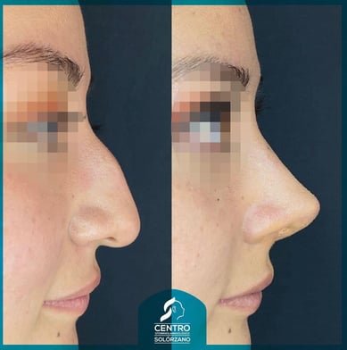 Resultados de Rinoplastia