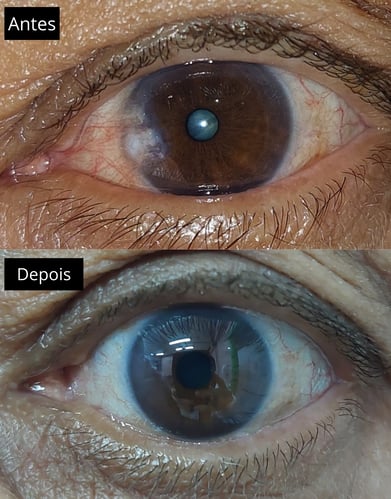 foto mostrando o antes e depois de uma cirurgia de pterigio, são paulo