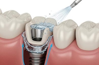 Entretien implant dentaire et hygiène implant dentaire hygiene-precision.com