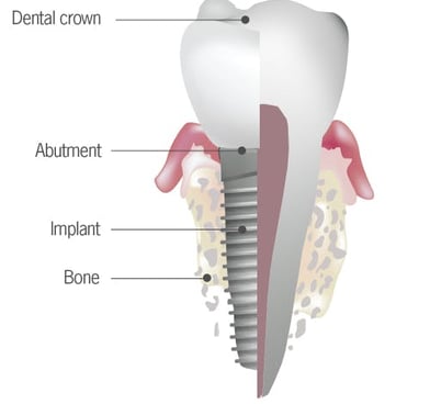 Best Dental Implants treatment in Wadgaon sheri pune