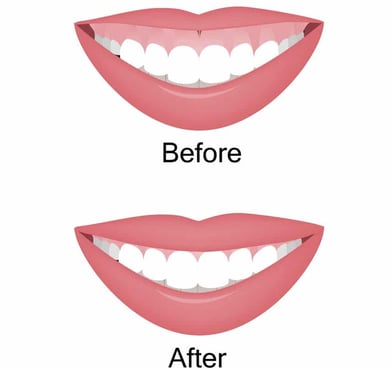 Gummy Smile Correction Treatment in Wadgaon Sheri