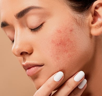 hyaluronic acid may cause redness , skin itching ,bruising.