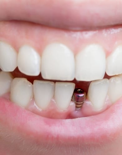 temps de cicatrisation implant