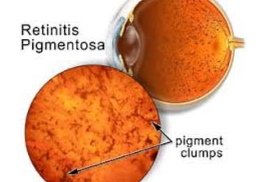 retinitis pigmentosa diagnosis