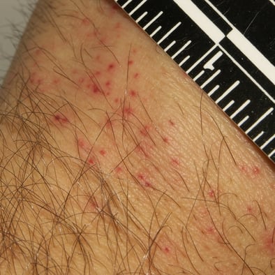 bed bug bites on persons arm