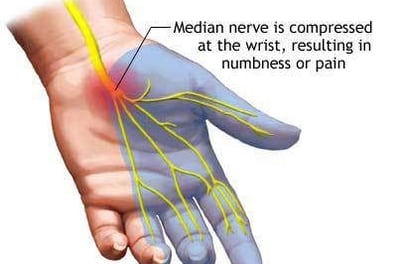 Carpal Tunnel Syndrome- Dr. T. Aravindh MBBS, MS( ORTHO)