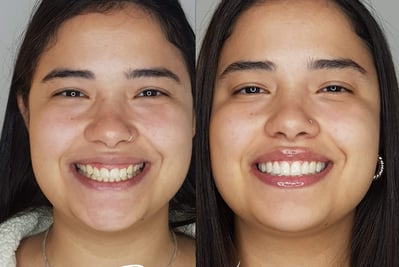 antes e depois